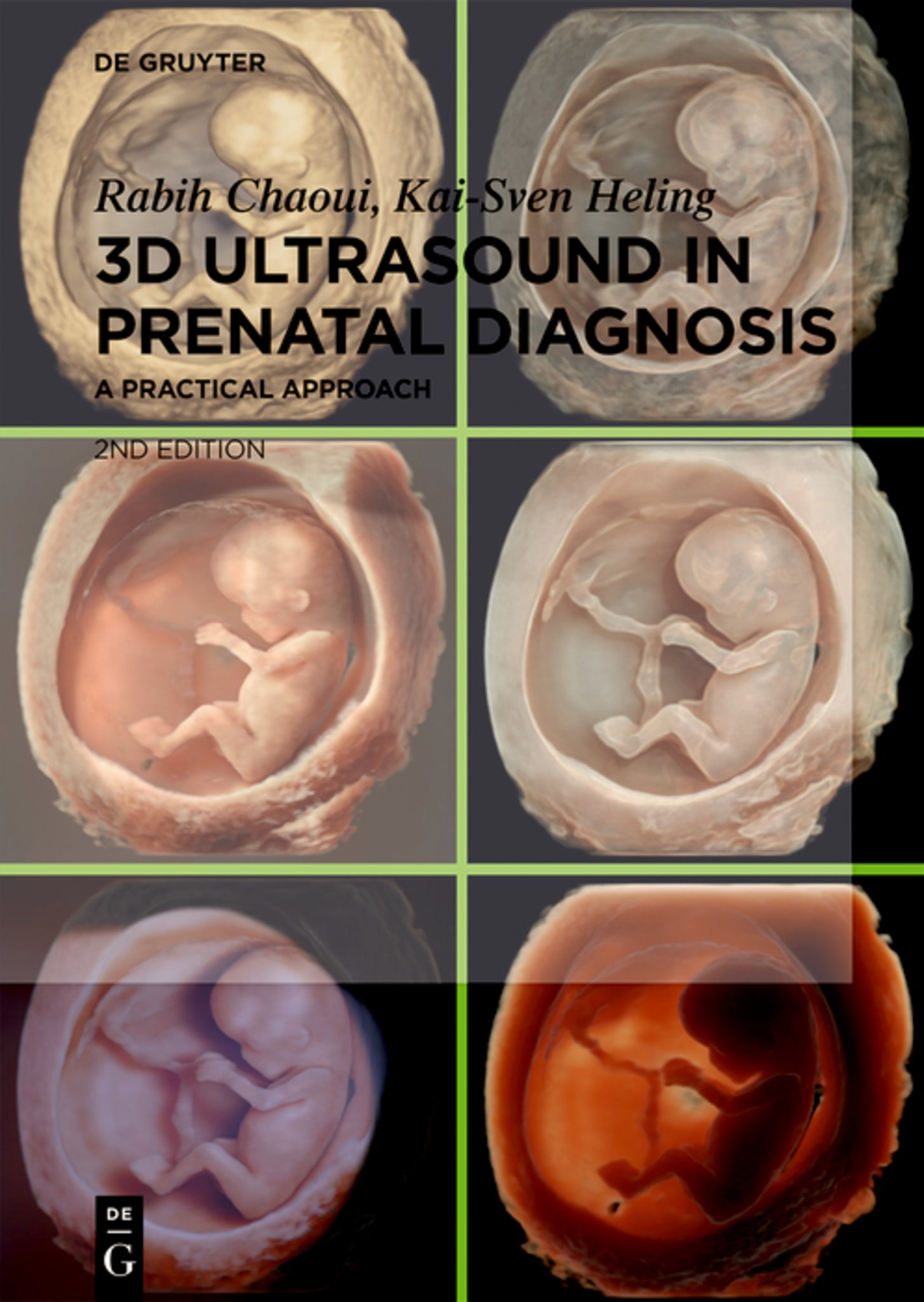 3D Ultrasound in Prenatal Diagnosis